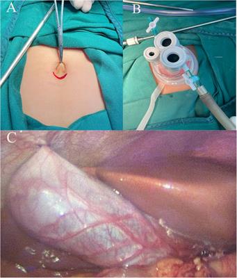 Gallbladder preserving cholelithotomy in children with hereditary spherocytosis complicated by gallstones: a single-center retrospective study